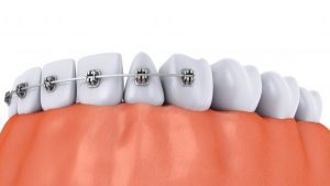 ارتودنسی بعد از ایمپلنت دندان