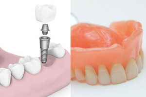 ایمپلنت دندان یا پروتز دندان