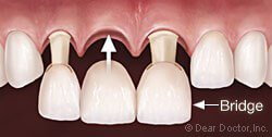 درمان با بریج پرسلین | ریکاوری بریج دندان