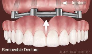 ایمپلنت های حمایت کننده پروتز دندان