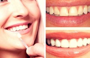 تفاوت لمینت دندان و باندینگ دندان