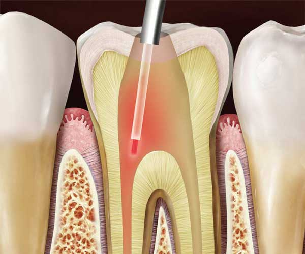 درمان ریشه دندان با لیزر