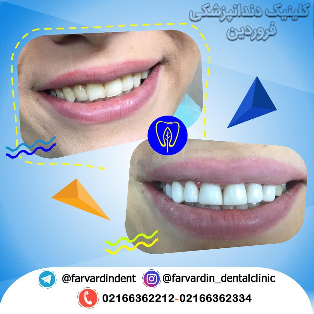 before after (4)