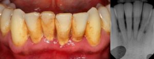 پاکسازی عمیق دندان در بیماری پریودنتال
