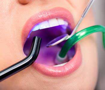 کاربرد لیزر دندانپزشکی