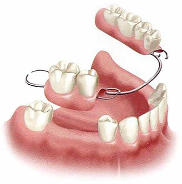 دندان مصنوعی فلیپر یا ایمپلنت دندان