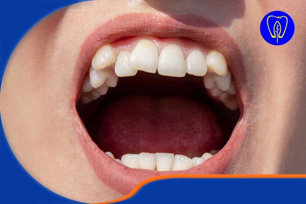 اصلاح نامرتبی‌های شدید و دندان‌های نهفته یا نابجا