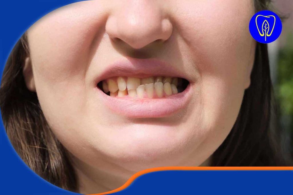 ناهماهنگی‌های فکی