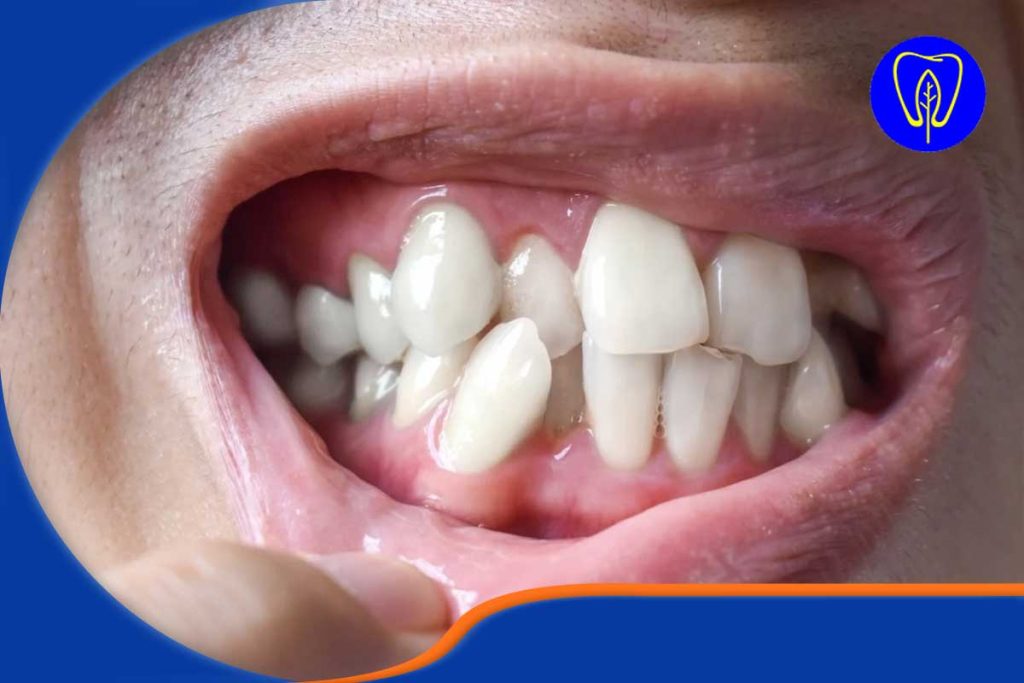 کمبود شدید فضا و شلوغی دندان‌ها