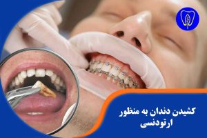 کشیدن دندان به منظور ارتودنسی