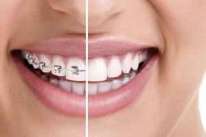 ارتودنسی و ایمپلنت