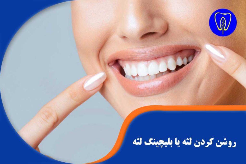 روشن کردن لثه یا بلیچینگ لثه :