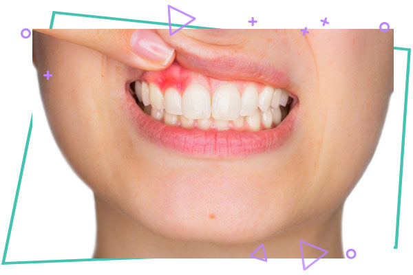 پریودنتیت در بارداری