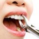 کشیدن دندان ها و ارتودنسی کردن