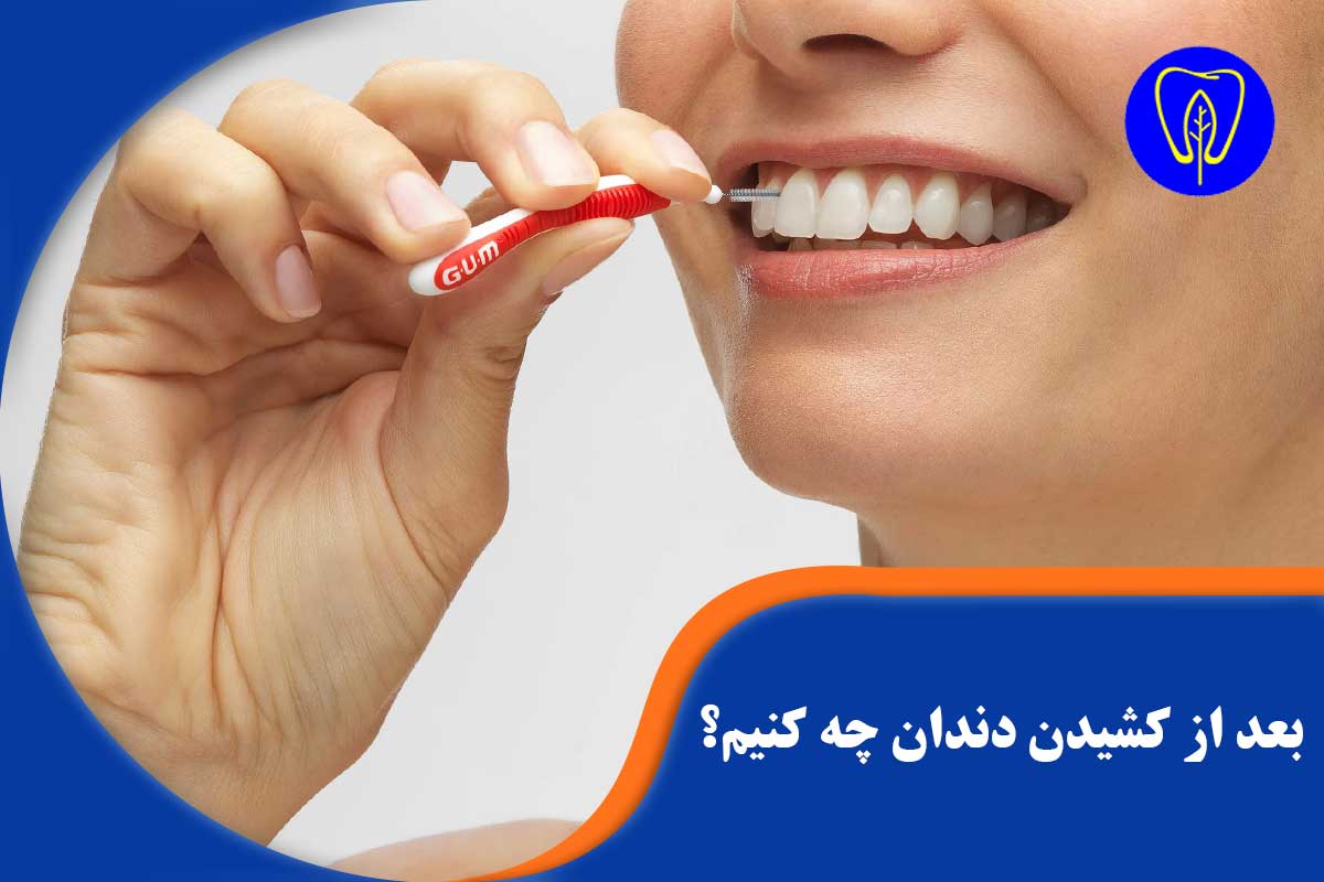 مراقبت‌های پس از کشیدن دندان