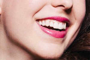 بهترین سن لمینت دندان