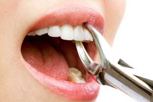 سوکت خشک بعد از کشیدن دندان