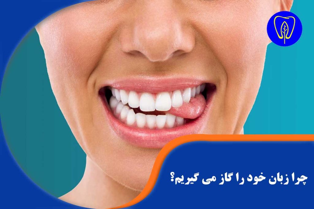 گاز گرفتن زبان