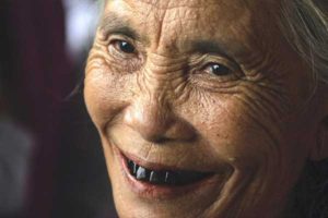 عوامل سیاه شدن دندان