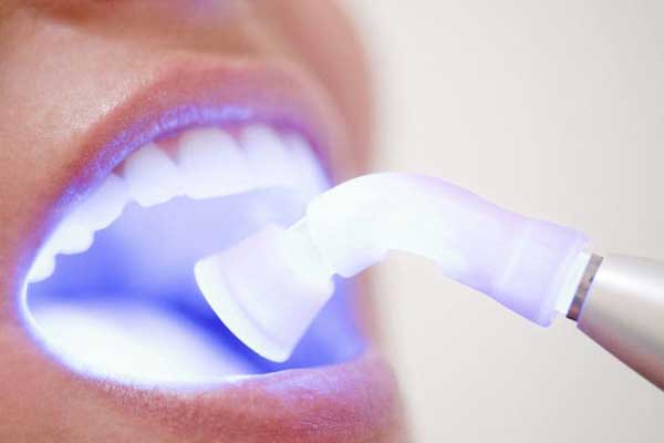 کاربرد لیزر دندانپزشکی | لیزر لثه