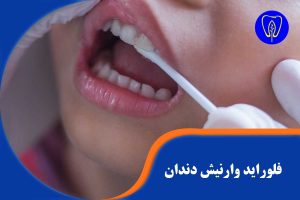 فلوراید وارنیش