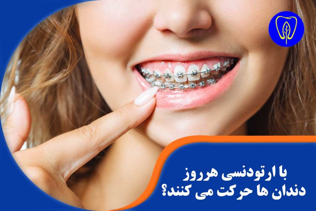 حرکت هر روز دندان با ارتودنسی