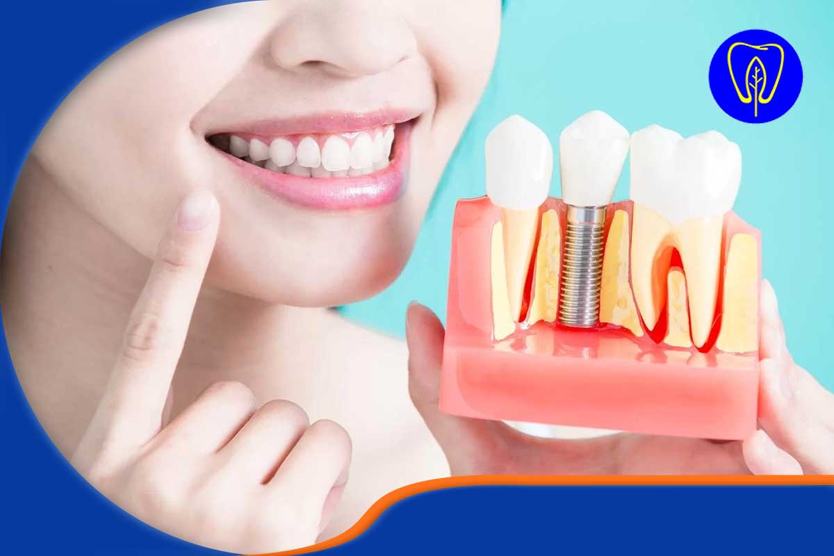 دندان چسبی بهتر است یا ایمپلنت؟