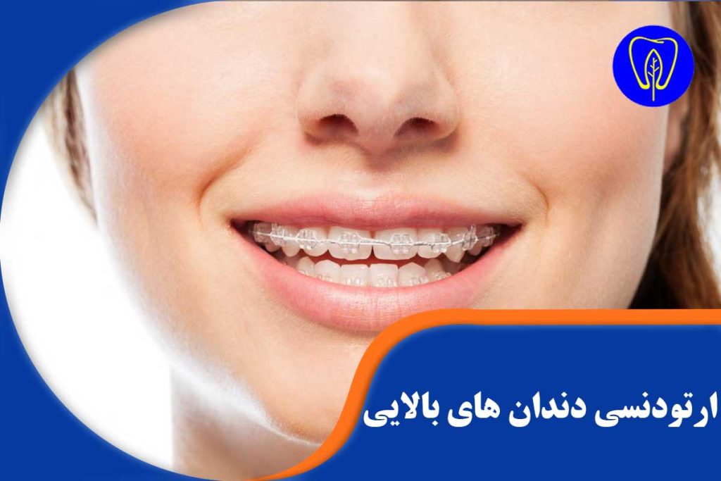 ارتودنسی دندان های بالایی