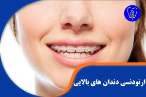 ارتودنسی دندان های بالایی