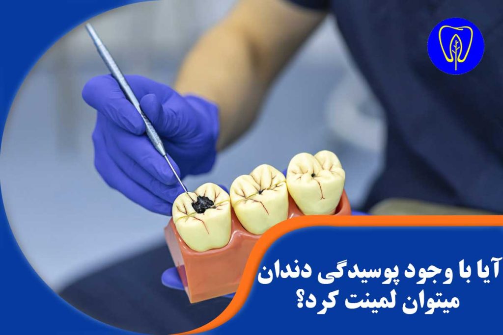 لمینت دندان پوسیده