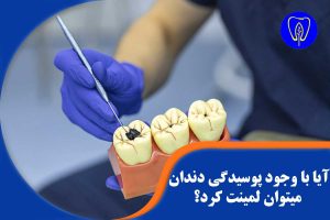 لمینت دندان پوسیده