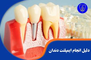 دلیل انجام ایمپلنت دندان