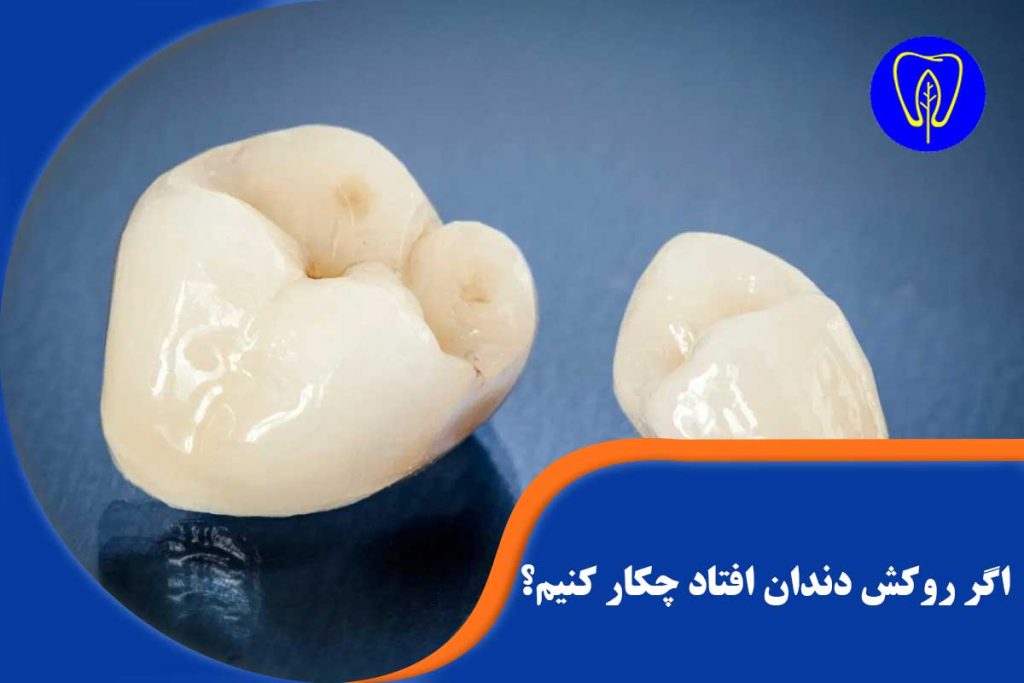 افتادن روکش دندان