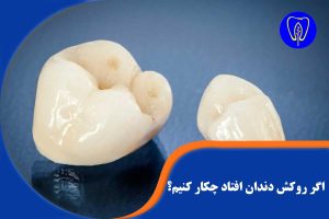 افتادن روکش دندان