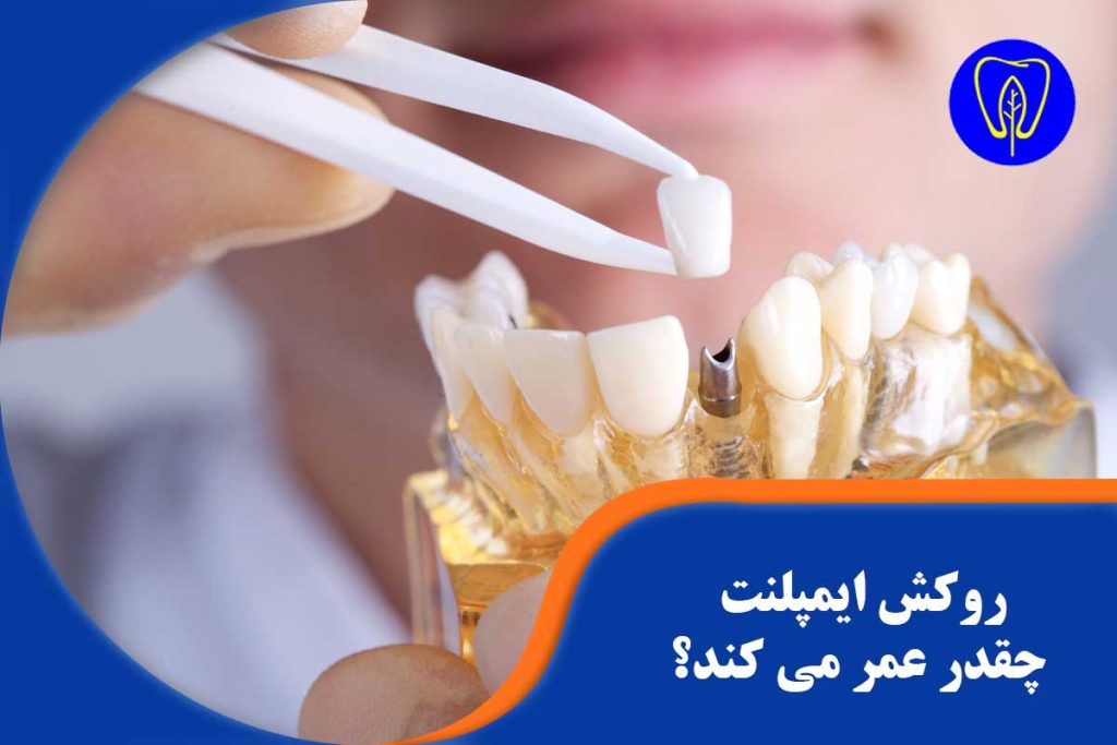 روکش ایمپلنت دندان