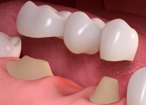 بریج دندان چگونه کار می کند؟