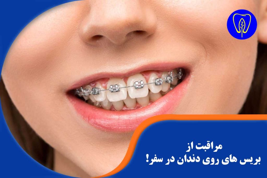 مراقبت از بریس های روی دندان در سفر