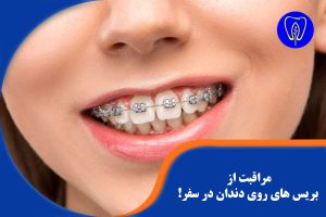 مراقبت از بریس های روی دندان در سفر