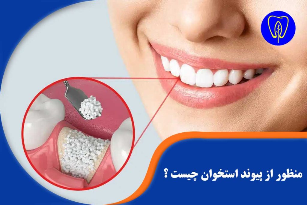 پیوند استخوان در دندانپزشکی