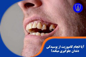 کامپوزیت از پوسیدگی دندان جلوگیری میکند؟