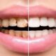 آیا انجام کامپوزیت از پوسیدگی دندان جلوگیری میکند؟