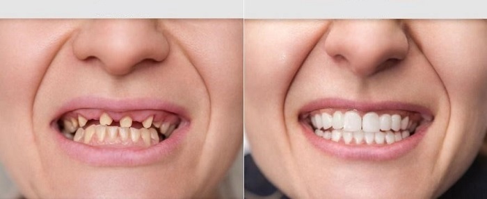 تفاوت روکش با ترمیم دندان