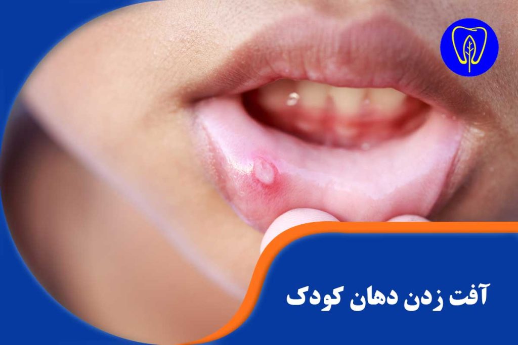 آفت زدن دهان کودک