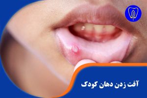 آفت زدن دهان کودک