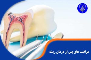 مراقبت های پس از درمان ریشه