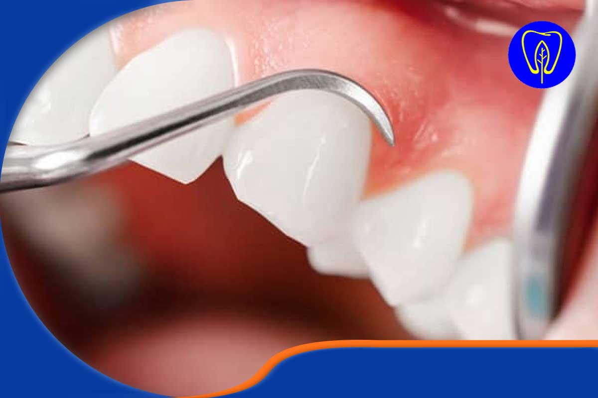 انواع ترمیم دندان