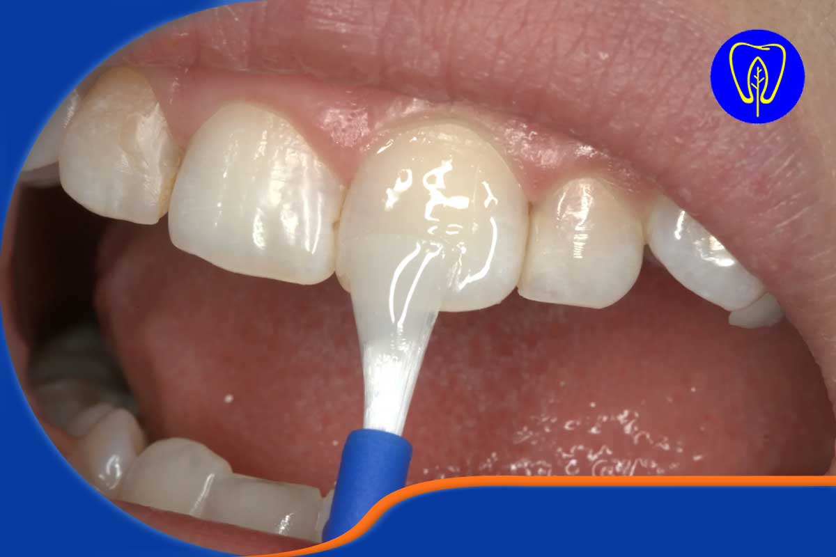 انجام فلوراید وارنیش 