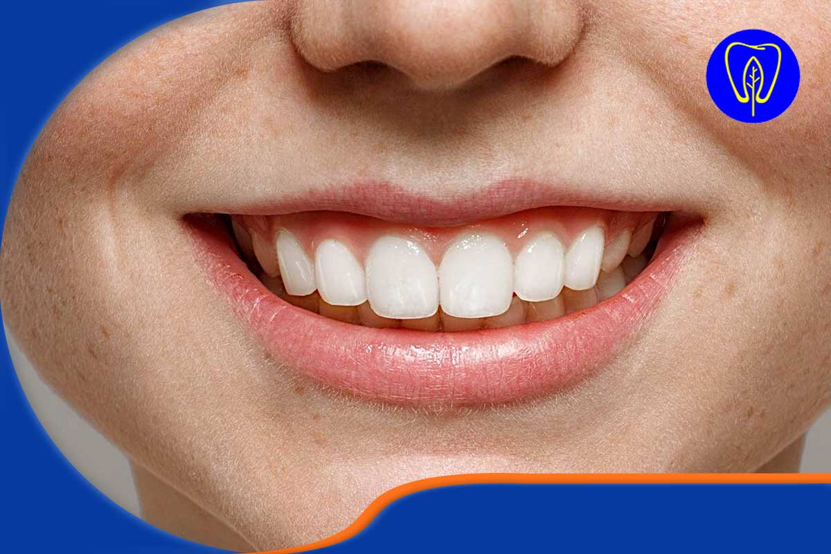 مزایای فلوراید وارنیش دندان