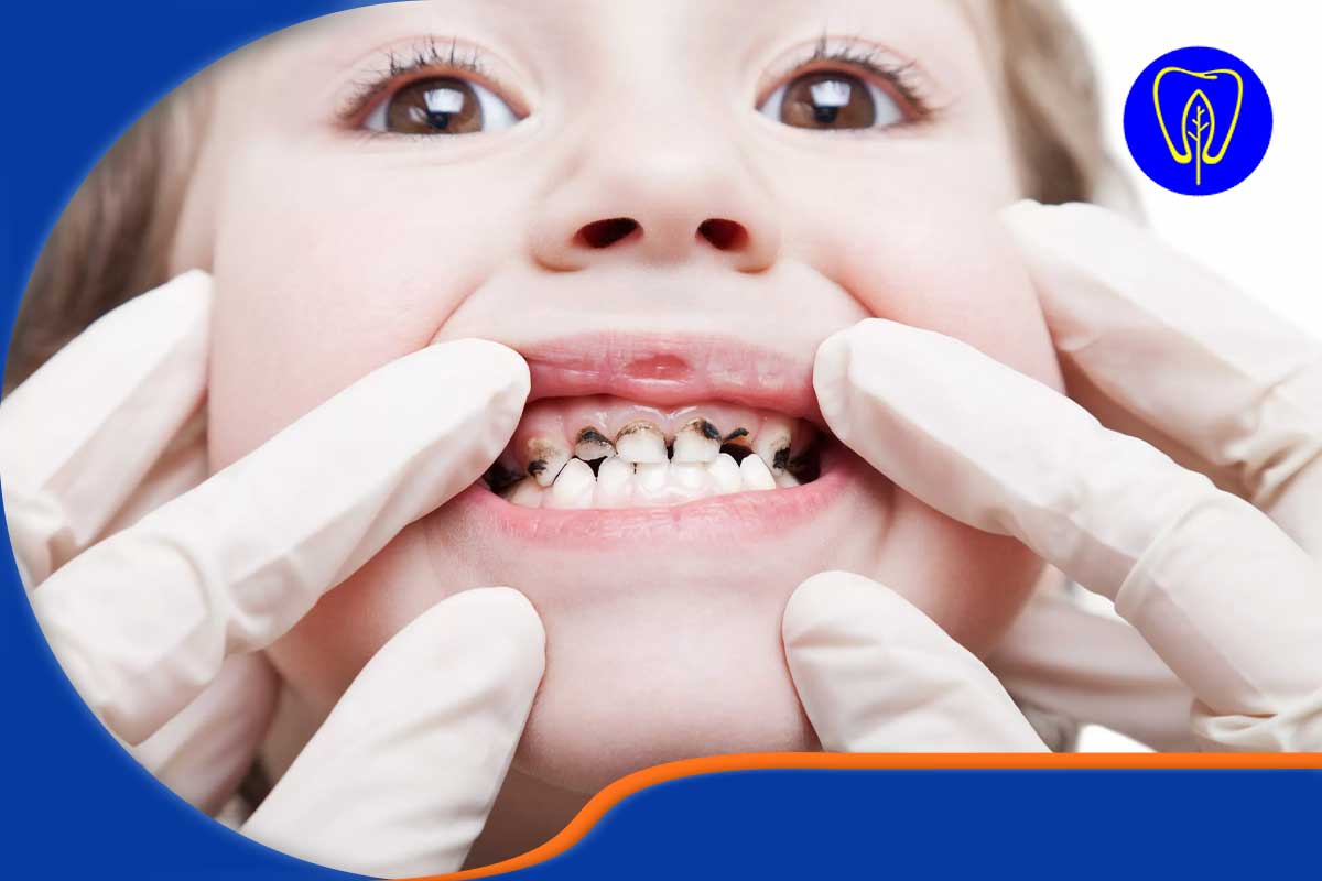  پوسیدگی دندان‌های کودک 