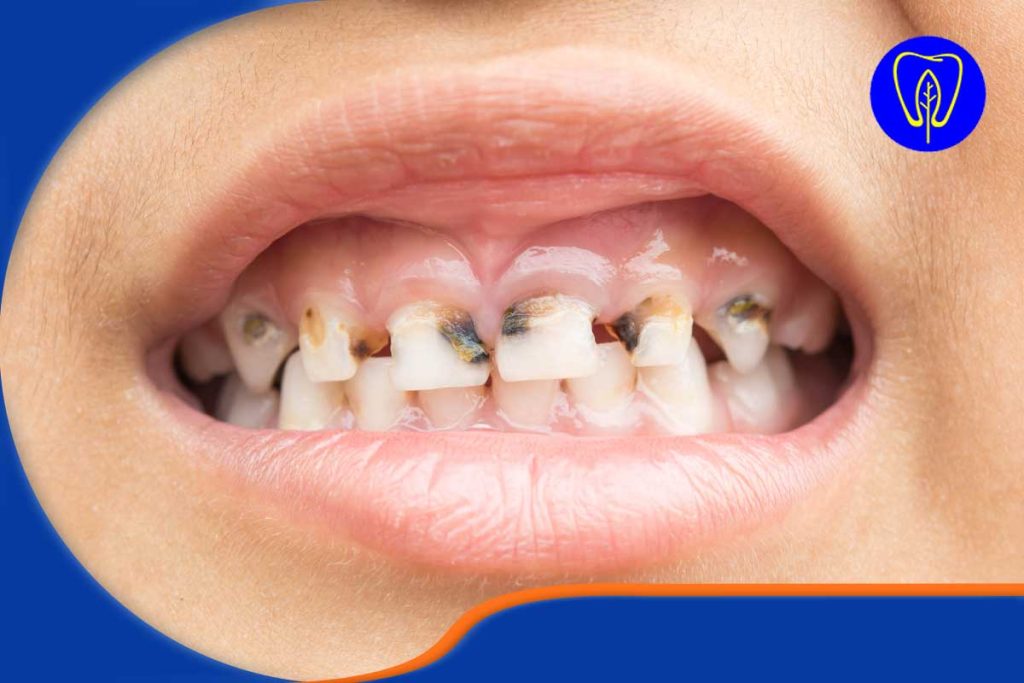 پوسیدگی دندان کودکان